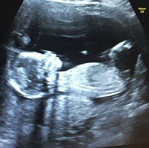 Ultrasound photo of a fetus